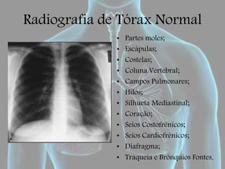 Radiografia de Tórax Normal
• Partes moles;
• Escápulas;
• Costelas;
• Coluna Vertebral;
• Campos Pulmonares;
• Hilos;
• Silhueta Mediastinal;
• Coração;
• Seios Costofrênicos;
• Seios Cardiofrênicos;
• Diafragma;
• Traqueia e Brônquios Fontes.
 