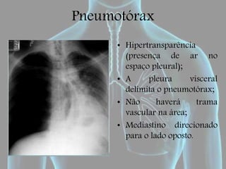 Pneumotórax
• Hipertransparência
(presença de ar no
espaço pleural);
• A pleura visceral
delimita o pneumotórax;
• Não haverá trama
vascular na área;
• Mediastino direcionado
para o lado oposto.
 