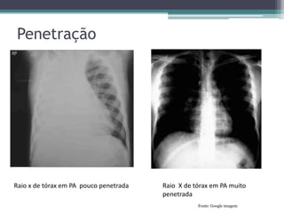 Penetração
Raio x de tórax em PA pouco penetrada Raio X de tórax em PA muito
penetrada
Fonte: Google imagem
 