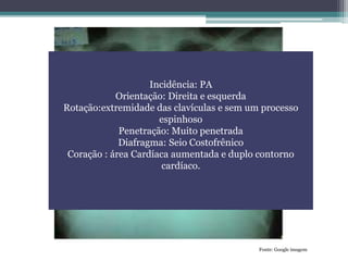 Incidência: PA
Orientação: Direita e esquerda
Rotação:extremidade das clavículas e sem um processo
espinhoso
Penetração: Muito penetrada
Diafragma: Seio Costofrênico
Coração : área Cardíaca aumentada e duplo contorno
cardíaco.
Fonte: Google imagem
 