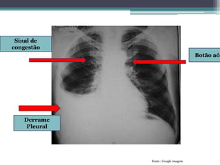 Derrame
Pleural
Sinal de
congestão
Botão aór
Fonte : Google imagem
 