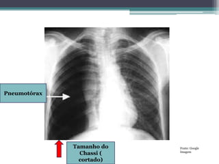Pneumotórax
Tamanho do
Chassi (
cortado)
Fonte: Google
Imagem
 