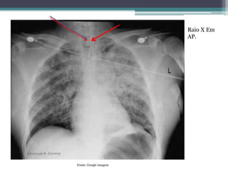 Fonte: Google imagem
Raio X Em
AP.
 