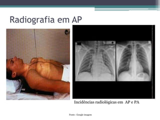 Radiografia em AP
Incidências radiológicas em AP e PA
Fonte : Google imagem
 
