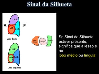 Se Sinal da Silhueta
estiver presente,
significa que a lesão é
no
lobo médio ou língula.
 