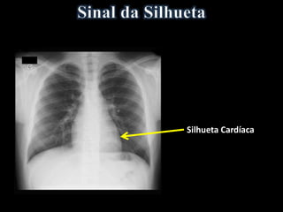 Silhueta Cardíaca
 