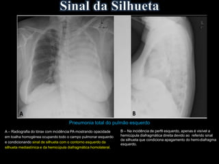 Pneumonia total do pulmão esquerdo
A – Radiografia do tórax com incidência PA mostrando opacidade
em toalha homogénea ocupando todo o campo pulmonar esquerdo
e condicionando sinal de silhueta com o contorno esquerdo da
silhueta mediastínica e da hemicúpula diafragmática homolateral.
B – Na incidência de perfil esquerdo, apenas é visível a
hemicúpula diafragmática direita devido ao referido sinal
da silhueta que condiciona apagamento do hemi-diafragma
esquerdo.
 