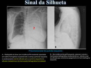Pneumonia total do pulmão esquerdo
A – Radiografia do tórax com incidência PA mostrando opacidade
em toalha homogénea ocupando todo o campo pulmonar esquerdo
e condicionando sinal de silhueta com o contorno esquerdo da
silhueta mediastínica e da hemicúpula diafragmática homolateral.
B – Na incidência de perfil esquerdo, apenas é visível a
hemicúpula diafragmática direita devido ao referido sinal
da silhueta que condiciona apagamento do hemi-diafragma
esquerdo.
?
 