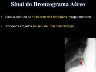 • Visualização do Ar no interior dos brônquios intrapulmonares
• Brônquios arejados no seio de uma consolidação
 