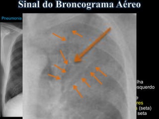 Pneumonia Lobar Esquerda
Opacidade em toalha
ocupando o lobo esquerdo
e a língula,
individualizando-se
opacidades tubulares
radiotransparentes (seta)
na região central - seta
 