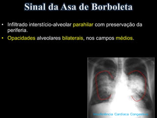 • Infiltrado interstício-alveolar parahilar com preservação da
periferia.
• Opacidades alveolares bilaterais, nos campos médios.
 