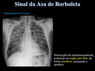 Diminuição da radiotransparência
pulmonar na região peri-hilar, de
forma simétrica, poupando a
periferia.
Edema Agudo de Pulmão
 