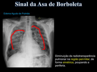 Diminuição da radiotransparência
pulmonar na região peri-hilar, de
forma simétrica, poupando a
periferia.
Edema Agudo de Pulmão
 