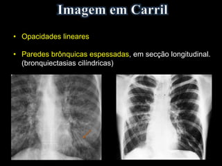 • Opacidades lineares
• Paredes brônquicas espessadas, em secção longitudinal.
(bronquiectasias cilíndricas)
 
