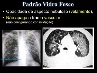 • Opacidade de aspecto nebuloso (velamento),
• Não apaga a trama vascular
(não configurando consolidação)
Infecção Micobacteriana
 