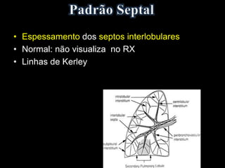 • Espessamento dos septos interlobulares
• Normal: não visualiza no RX
• Linhas de Kerley
 