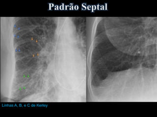 Linhas A, B, e C de Kerley
 