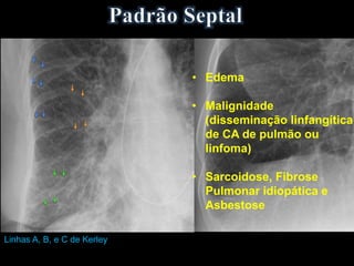 Linhas A, B, e C de Kerley
• Edema
• Malignidade
(disseminação linfangítica
de CA de pulmão ou
linfoma)
• Sarcoidose, Fibrose
Pulmonar idiopática e
Asbestose
 
