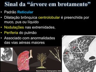 • Padrão Reticular
• Dilatação brônquica centrolobular é preenchida por
muco, pus ou líquido
• Nodulações nas extremidades,
• Periferia do pulmão
• Associado com anormalidades
das vias aéreas maiores
 