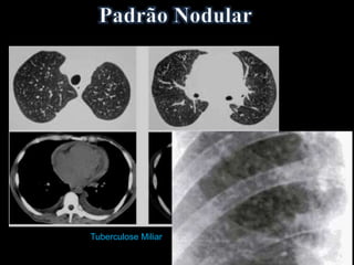 Tuberculose Miliar
 