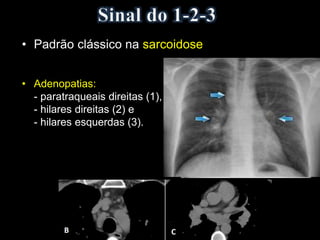 • Padrão clássico na sarcoidose
• Adenopatias:
- paratraqueais direitas (1),
- hilares direitas (2) e
- hilares esquerdas (3).
 