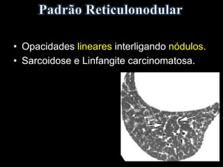 • Opacidades lineares interligando nódulos.
• Sarcoidose e Linfangite carcinomatosa.
 