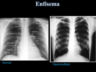Normal
Hiperinsuflado
 