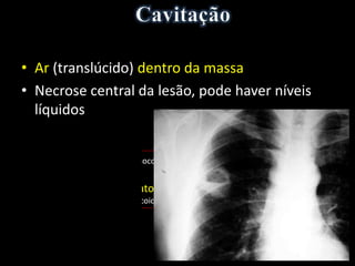 • Ar (translúcido) dentro da massa
• Necrose central da lesão, pode haver níveis
líquidos
• Abscesso (staphylococcus)
• Neoplasia
• Massa granulomatosa (tuberculose, fungo - aspergilose e
coccidioidomicose, sarcoidose, doença de Wegener, nódulo reumatóide)
 