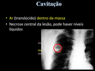 • Ar (translúcido) dentro da massa
• Necrose central da lesão, pode haver níveis
líquidos
• Abscesso (staphylococcus)
• Neoplasia
• Massa granulomatosa (tuberculose, fungo - aspergilose e
coccidioidomicose, sarcoidose, doença de Wegener, nódulo reumatóide)
 