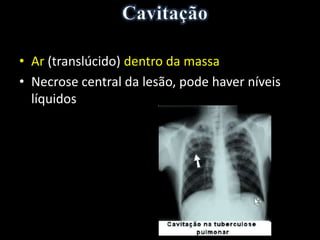 • Ar (translúcido) dentro da massa
• Necrose central da lesão, pode haver níveis
líquidos
• Abscesso (staphylococcus)
• Neoplasia
• Massa granulomatosa (tuberculose, fungo - aspergilose e
coccidioidomicose, sarcoidose, doença de Wegener, nódulo reumatóide)
 