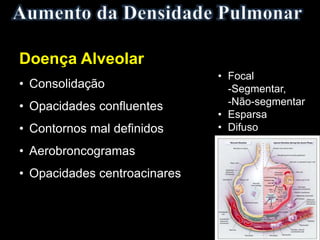• Consolidação
• Opacidades confluentes
• Contornos mal definidos
• Aerobroncogramas
• Opacidades centroacinares
Doença Alveolar
• Focal
-Segmentar,
-Não-segmentar
• Esparsa
• Difuso
 