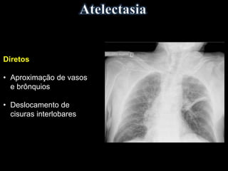 Diretos
• Aproximação de vasos
e brônquios
• Deslocamento de
cisuras interlobares
 