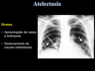 Diretos
• Aproximação de vasos
e brônquios
• Deslocamento de
cisuras interlobares
 