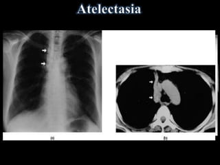 Diretos
• Aproximação de vasos
e brônquios
• Deslocamento de
cisuras interlobares
 