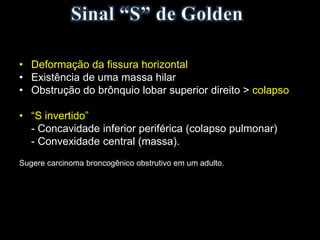 • Deformação da fissura horizontal
• Existência de uma massa hilar
• Obstrução do brônquio lobar superior direito > colapso
• “S invertido”
- Concavidade inferior periférica (colapso pulmonar)
- Convexidade central (massa).
Sugere carcinoma broncogênico obstrutivo em um adulto.
 