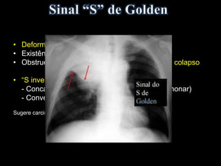 • Deformação da fissura horizontal
• Existência de uma massa hilar
• Obstrução do brônquio lobar superior direito > colapso
• “S invertido”
- Concavidade inferior periférica (colapso pulmonar)
- Convexidade central (massa).
Sugere carcinoma broncogênico obstrutivo em um adulto.
 