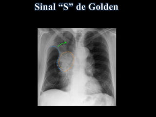 • Deformação da fissura horizontal
• Existência de uma massa hilar
• Obstrução do brônquio lobar superior direito > colapso
• “S invertido”
- Concavidade inferior periférica (colapso pulmonar)
- Convexidade central (massa).
Sugere carcinoma broncogênico obstrutivo em um adulto.
 