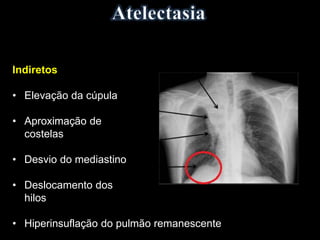 Indiretos
• Elevação da cúpula
• Aproximação de
costelas
• Desvio do mediastino
• Deslocamento dos
hilos
• Hiperinsuflação do pulmão remanescente
 