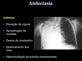Indiretos
• Elevação da cúpula
• Aproximação de
costelas
• Desvio do mediastino
• Deslocamento dos
hilos
• Hiperinsuflação do pulmão remanescente
 