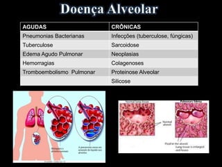 AGUDAS CRÔNICAS
Pneumonias Bacterianas Infecções (tuberculose, fúngicas)
Tuberculose Sarcoidose
Edema Agudo Pulmonar Neoplasias
Hemorragias Colagenoses
Tromboembolismo Pulmonar Proteinose Alveolar
Silicose
 