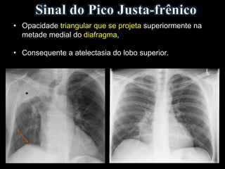 • Opacidade triangular que se projeta superiormente na
metade medial do diafragma,
• Consequente a atelectasia do lobo superior.
 