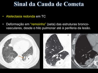 • Atelectasia redonda em TC
• Deformação em “remoinho” (seta) das estruturas bronco-
vasculares, desde o hilo pulmonar até à periferia da lesão.
 