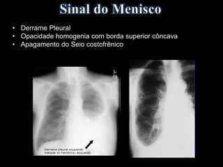 • Derrame Pleural
• Opacidade homogenia com borda superior côncava
• Apagamento do Seio costofrênico
 