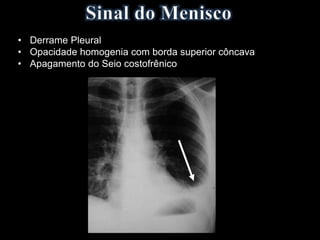 • Derrame Pleural
• Opacidade homogenia com borda superior côncava
• Apagamento do Seio costofrênico
 