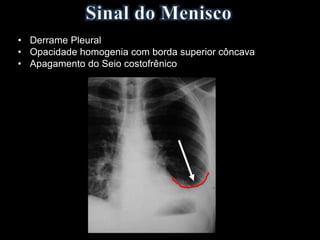• Derrame Pleural
• Opacidade homogenia com borda superior côncava
• Apagamento do Seio costofrênico
 