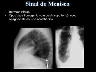 • Derrame Pleural
• Opacidade homogenia com borda superior côncava
• Apagamento do Seio costofrênico
 
