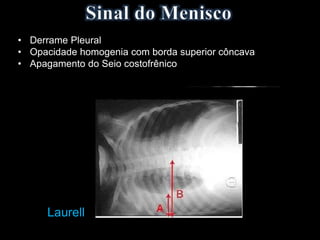 • Derrame Pleural
• Opacidade homogenia com borda superior côncava
• Apagamento do Seio costofrênico
Laurell
 