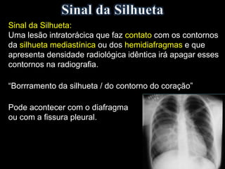 Sinal da Silhueta:
Uma lesão intratorácica que faz contato com os contornos
da silhueta mediastínica ou dos hemidiafragmas e que
apresenta densidade radiológica idêntica irá apagar esses
contornos na radiografia.
“Borrramento da silhueta / do contorno do coração”
Pode acontecer com o diafragma
ou com a fissura pleural.
 