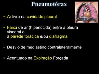 • Ar livre na cavidade pleural
• Faixa de ar (hiperlúcida) entre a pleura
visceral e:
a parede torácica e/ou diafragma
• Desvio de mediastino contralateralmente
• Acentuado na Expiração Forçada
 