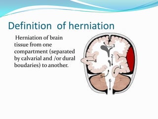 Definition of herniation
Herniation of brain
tissue from one
compartment (separated
by calvarial and /or dural
boudaries) to another.
 